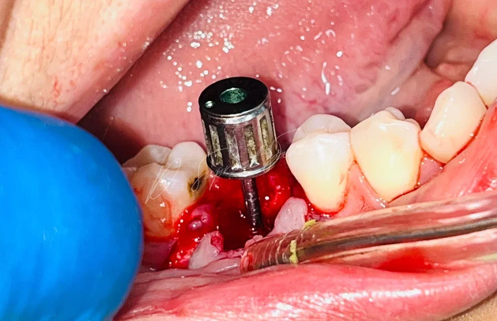 Intraoperative posterior mandibular view showing implant osteotomy instrumentation in position